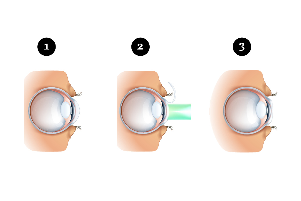 Como é feita a operação a laser para corrigir a miopia?