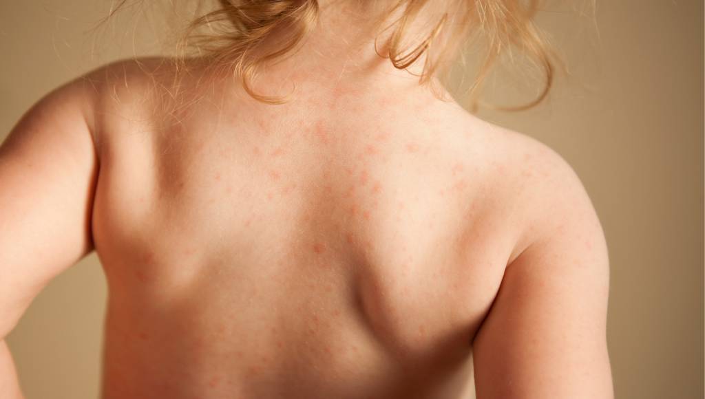 Como curar alergias ingerindo pedacinhos de plástico