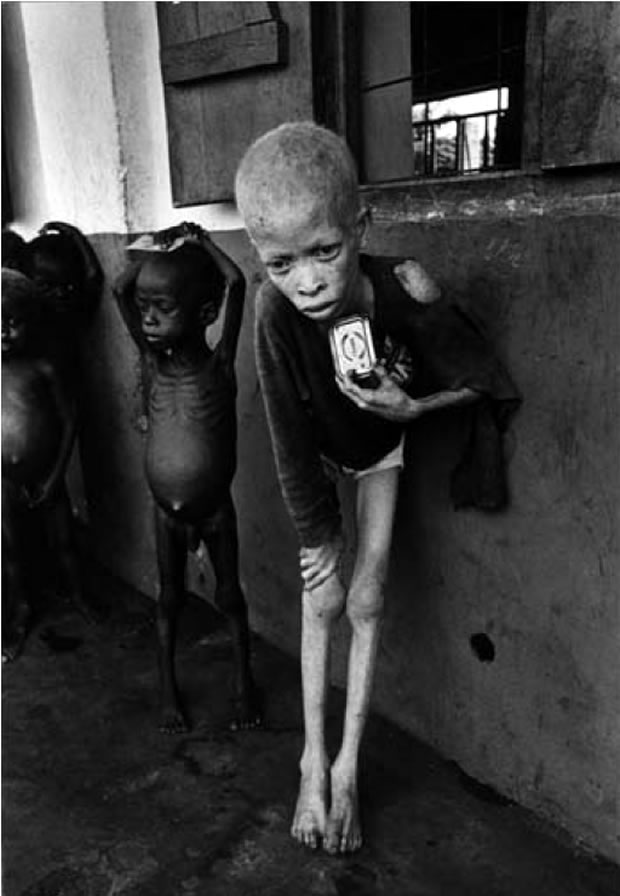 A Guerra Civil da Nigéria, ocorrida no final dos anos 1960, matou mais de um milhão de pessoas – a maioria, de fome. Nesta imagem, uma criança que desenvolveu Kwashiorkor, uma forma aguda de desnutrição.
