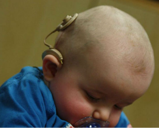 O implante coclear, também conhecido como ouvido biônico, foi lembrado por 4,1% dos internautas. Isso lhe rendeu o 7º lugar na lista.