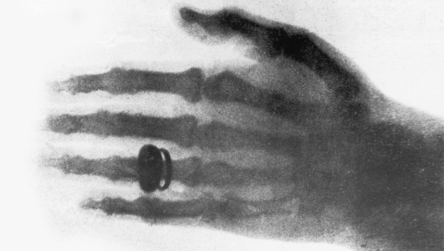 1896: Uma das primeiras fotografias de um raio x. Clicada em 1896, imagem mostra a mão da esposa do físico alemão Wilhelm Conrad Roentgen.