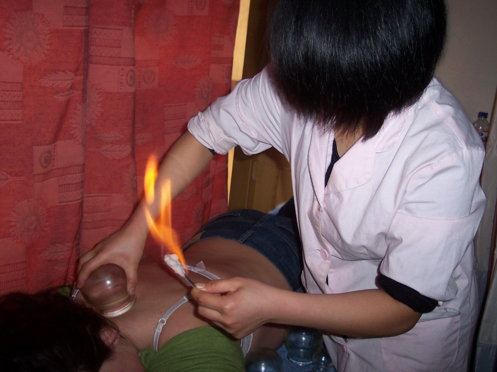 Fire_Cupping