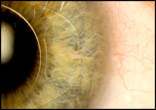 A foto mostra uma lente inserida cirurgicamente na íris de um paciente de 70 anos. Esse tipo de procedimento é feito para tratar problemas oculares musculares, como a miopia.