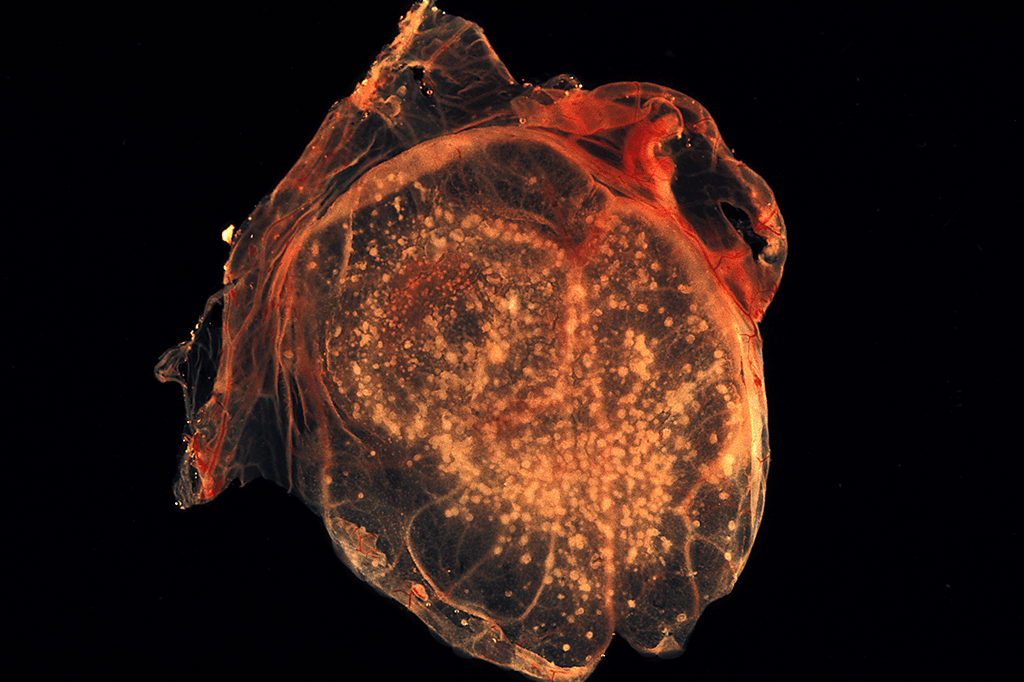 variola