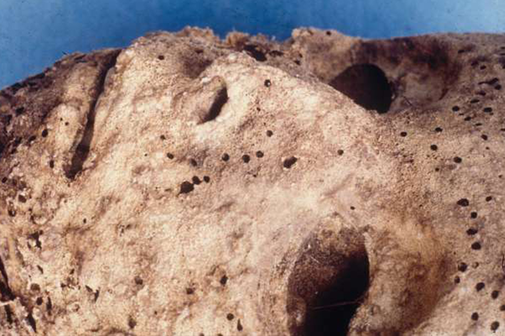 Descoberto vírus da hepatite B em múmia de 500 anos