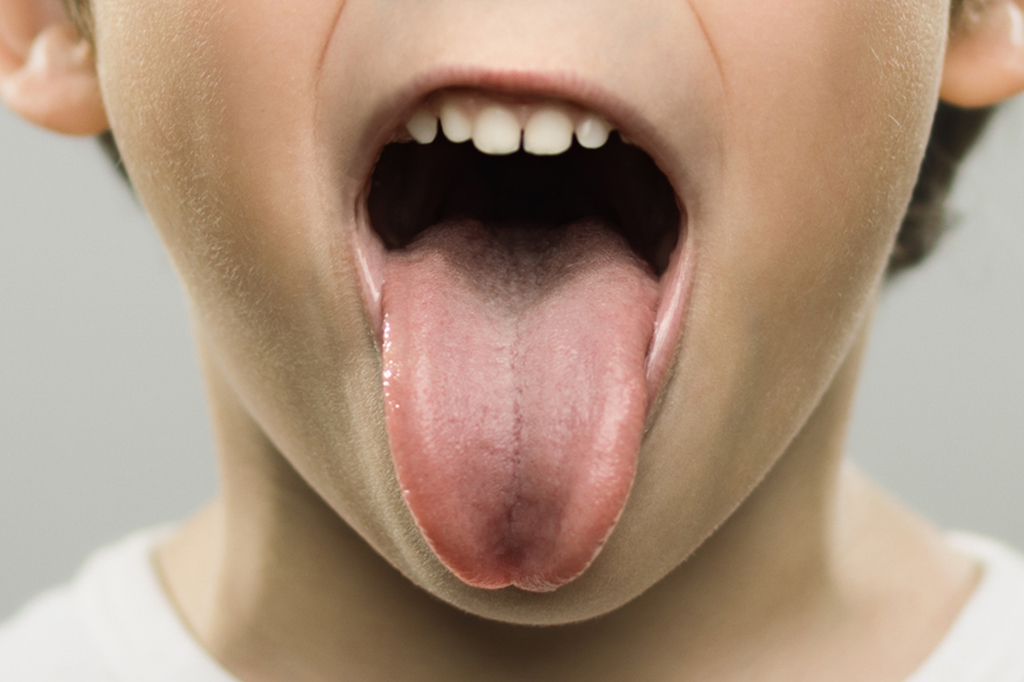 Remover as amígdalas pode triplicar o risco de doenças respiratórias