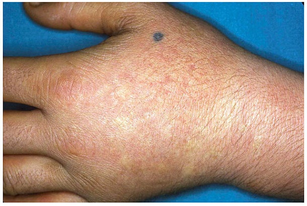 640px-Acute_photosensitivity_reaction_in_EPP