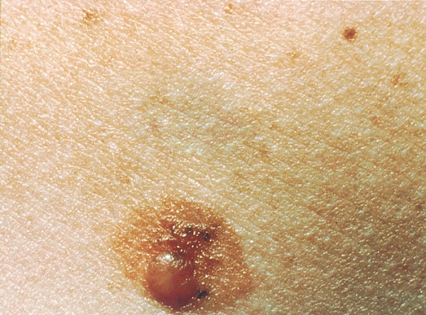 Como surgem as verrugas?