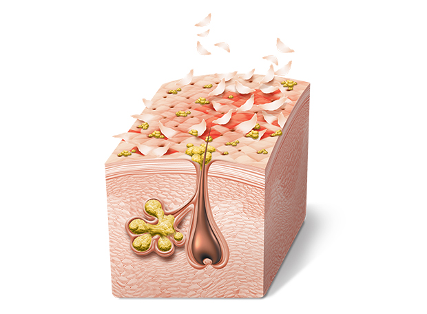 Pessoas carecas têm caspa?