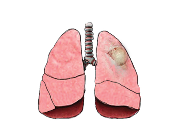 pulmão pus
