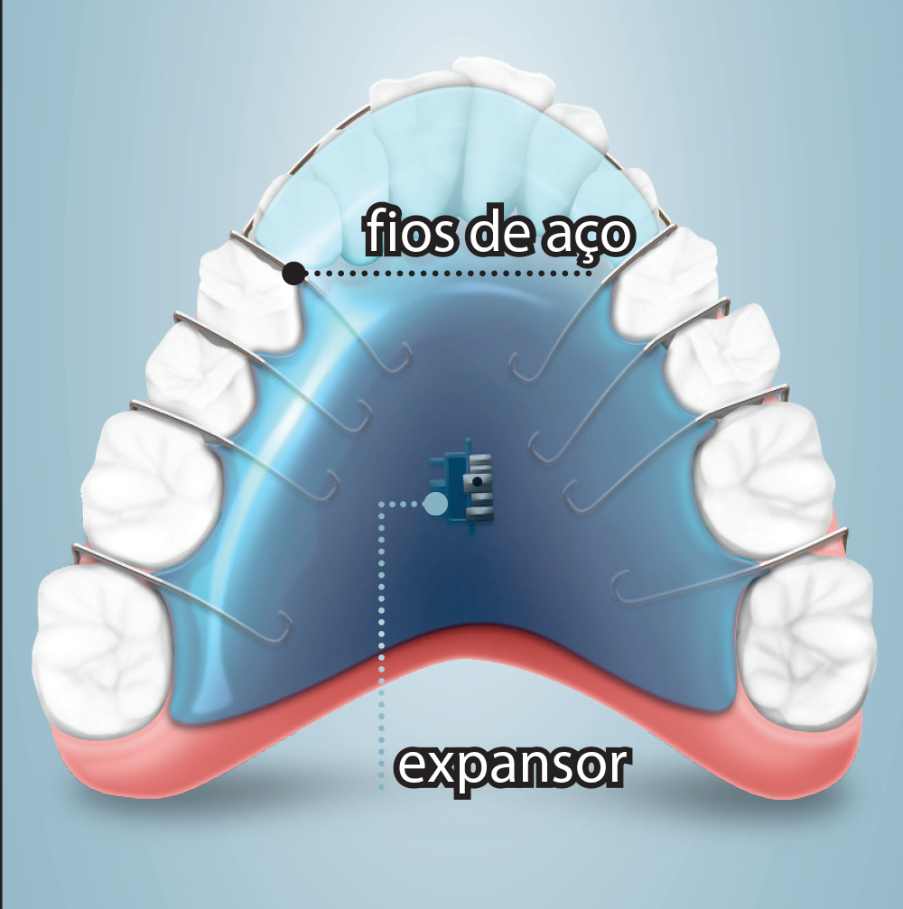 Como os aparelhos corrigem os dentes das pessoas?