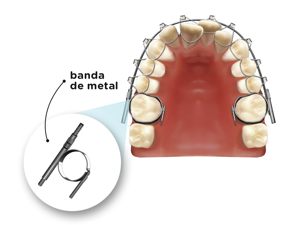 Aparelho ortodôntico Arco E