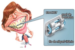 Como os aparelhos corrigem os dentes das pessoas?