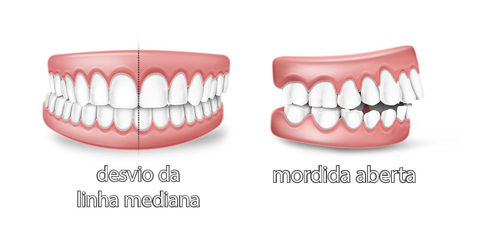 Como os aparelhos corrigem os dentes das pessoas?