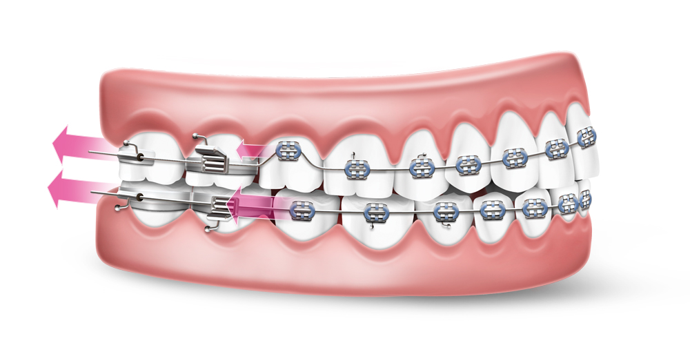 Como os aparelhos corrigem os dentes das pessoas?