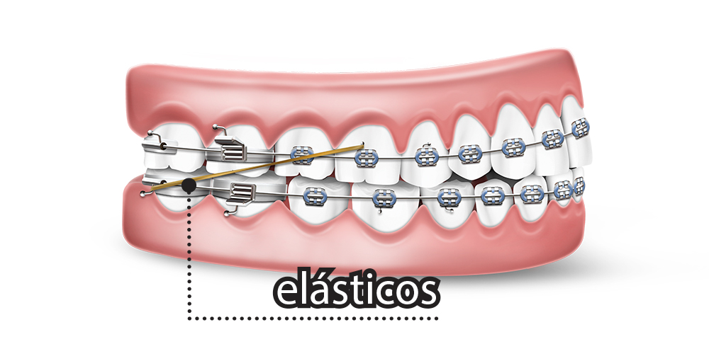 Como os aparelhos corrigem os dentes das pessoas?