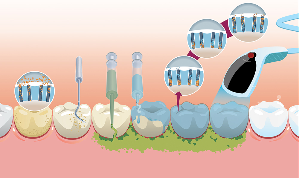Como é feito o clareamento dental?