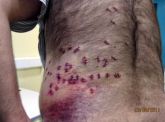 Homem sobrevive a 38 facadas porque estava acima do peso