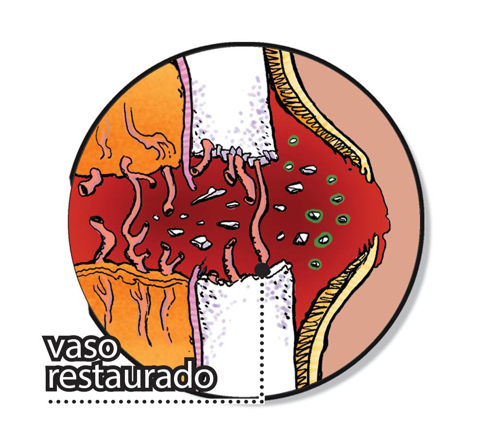 Como um osso quebrado se regenera?