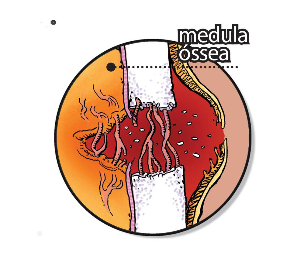 Como um osso quebrado se regenera?Fragmento4