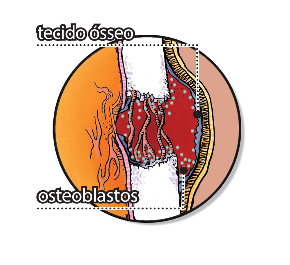 Como um osso quebrado se regenera?