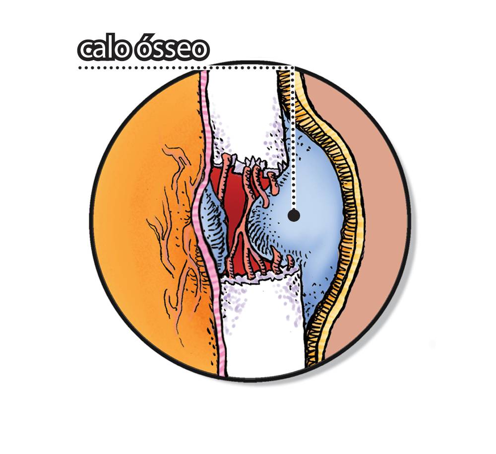 Como um osso quebrado se regenera?mu