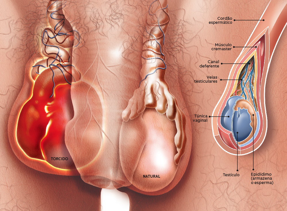 O que é uma torção de testículo?