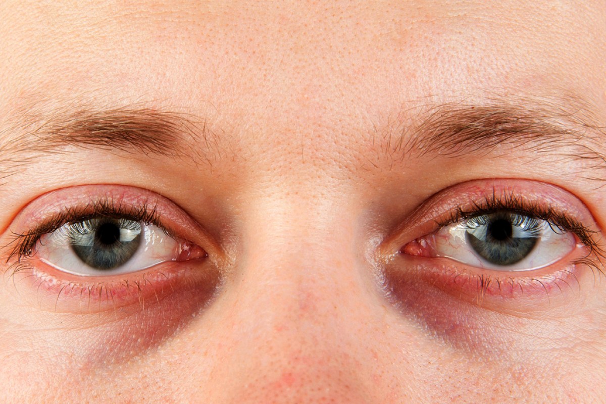 Черные круги под глазами причины заболевания. Красные синяки под глазами. Красные мешки под глазами. Красные синички под глазами.