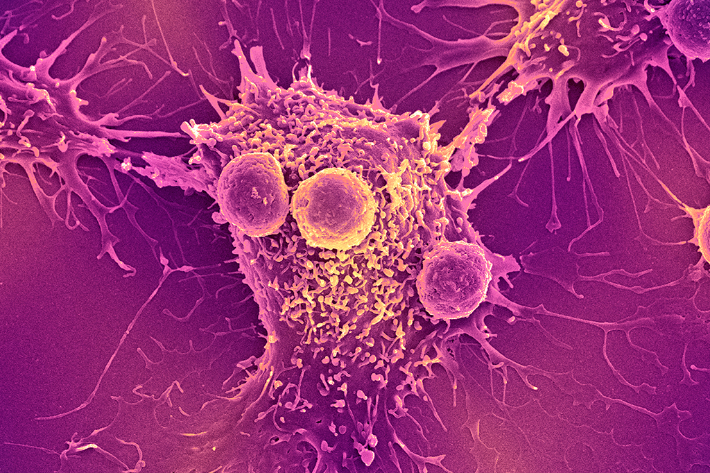 Entenda o tratamento do câncer testado em um paciente do Brasil pela 1ªvez