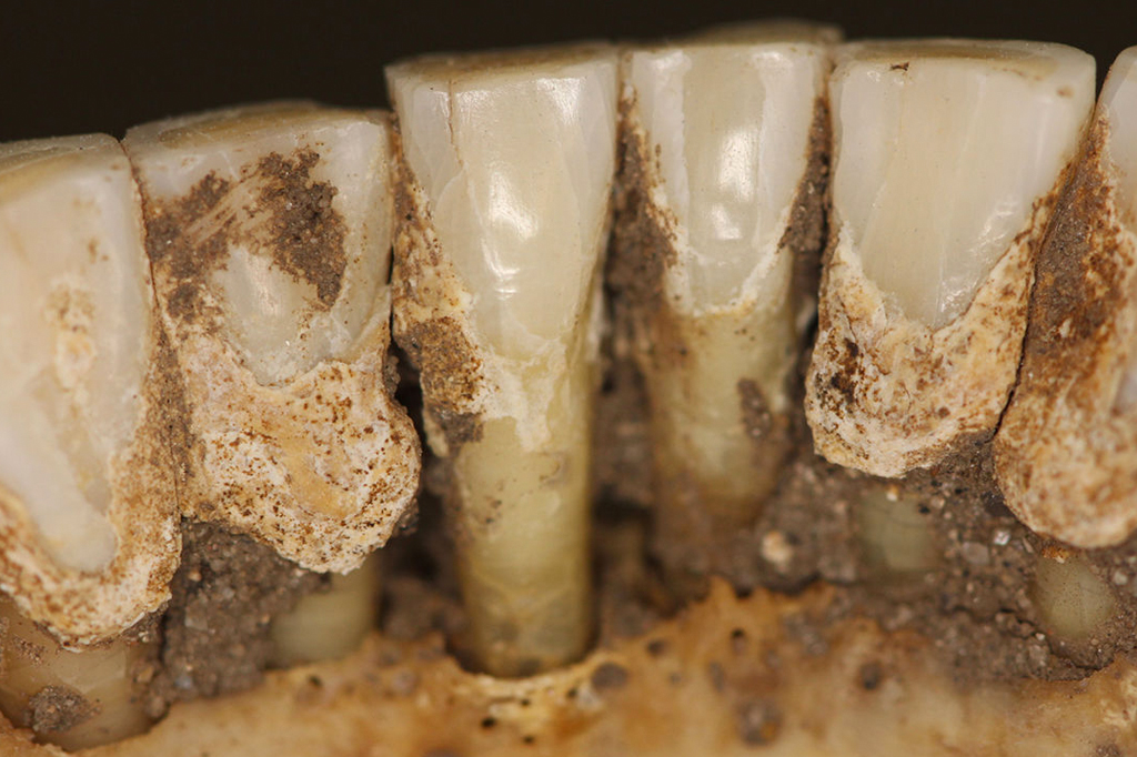 O tártaro cobre a superfície da língua dos dentes de um crânio que foi enterrado por décadas.