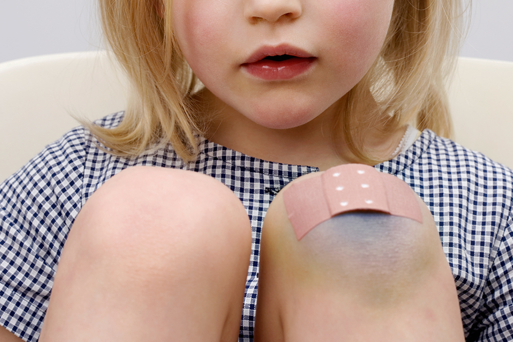 Criança com um hematoma no joelho esquerdo.