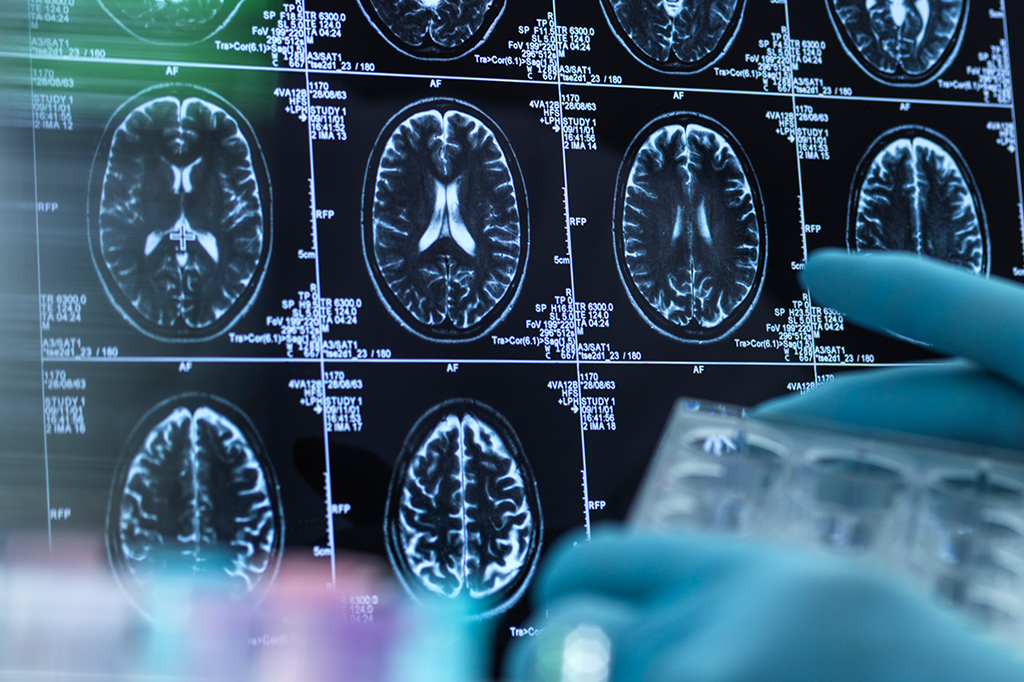Foto de resultado de exame de ressonância magnética cerebral.