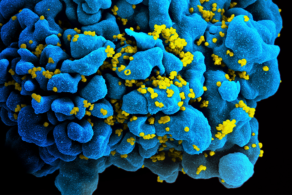 Célula T infectada com HIV.