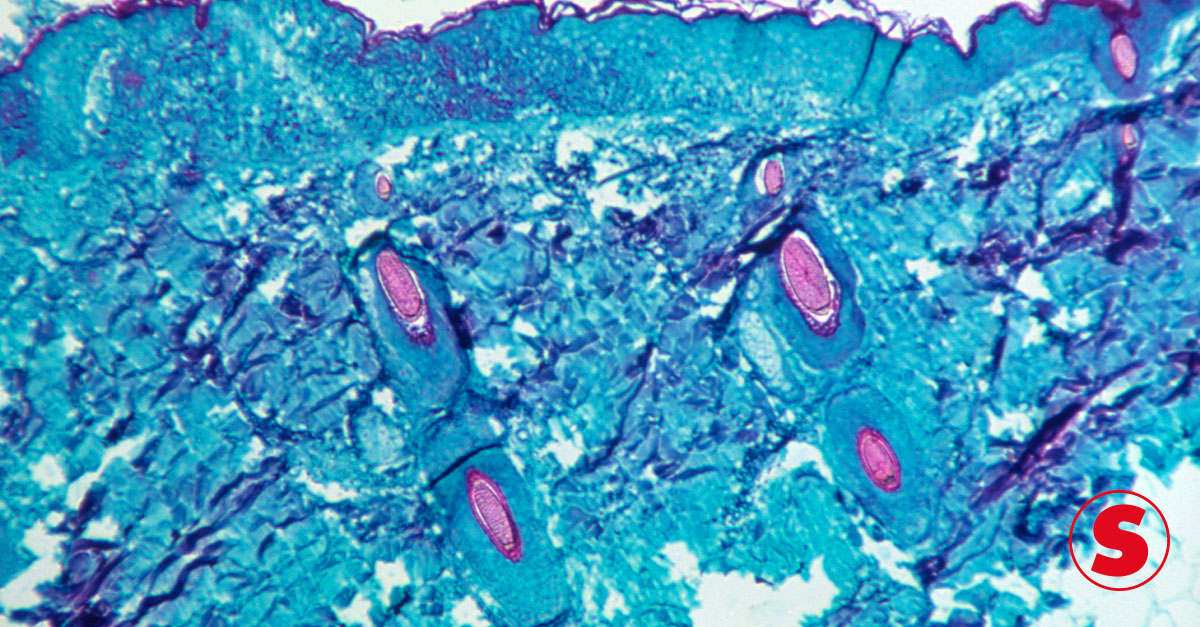 Imagem microscópica de lesão causada na pele de um macaco infectado com varíola.