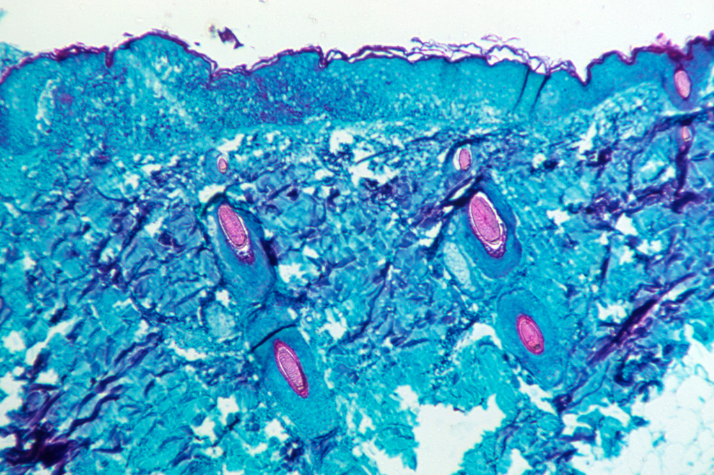 Imagem microscópica de lesão causada na pele de um macaco infectado com varíola.