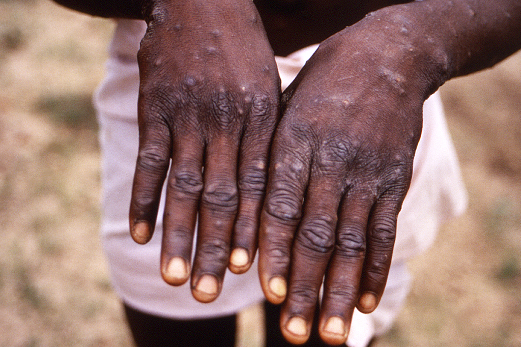 Lesões dermatológicas causadas pela varíola dos macacos.