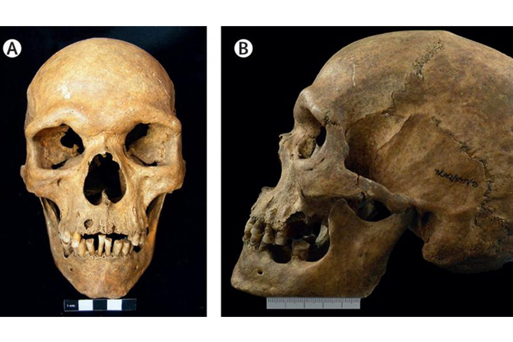 Duas fotos de um crânio: uma de frente e outra de perfil.