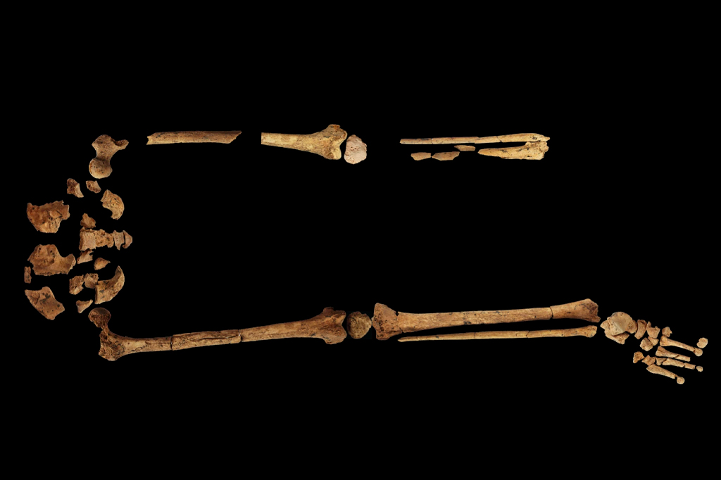 Fotografia dos fragmentos do esqueleto: pernas esquerda e direita com cintura pélvica, demonstrando a ausência completa do terço distal da perna esquerda.
