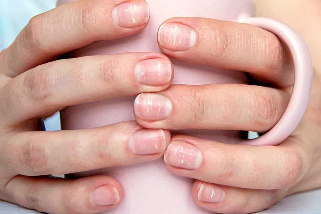Foto de uma mão segurando uma caneca; as unhas estão com muitas manchas brancas.