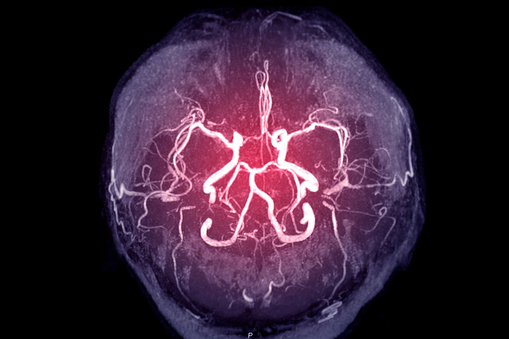 Ressonância magnética da artéria cerebral no cérebro.