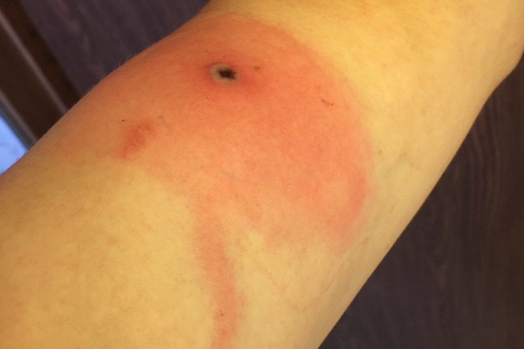 Uma lesão da varíola do Alasca cerca de 10 dias após o início dos sintomas.
