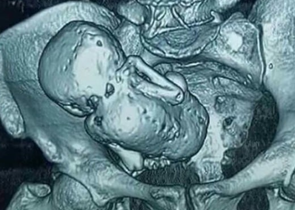 Ultrassonografia de um feto calcificado.