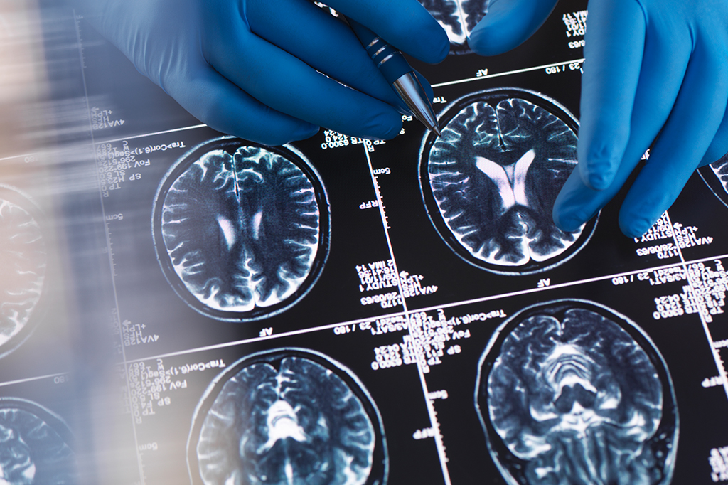 Alzheimer: cientistas descobrem um novo tipo genético da doença