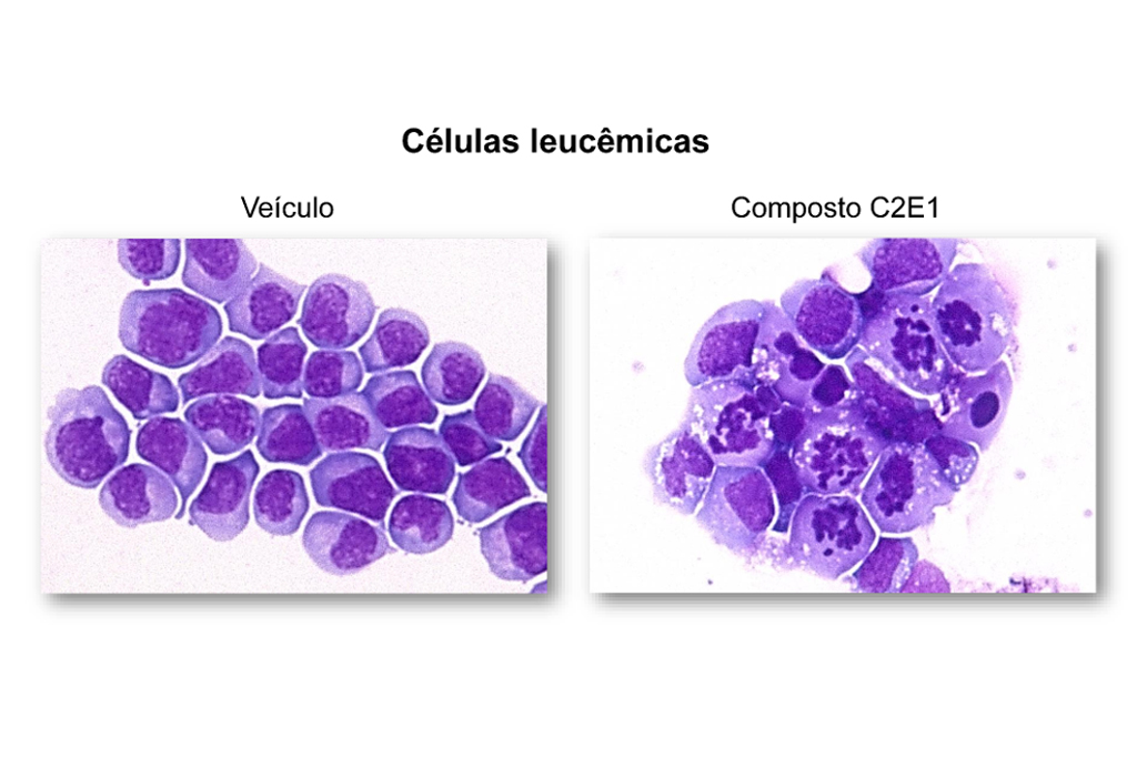 Duas imagens de c&eacute;lulas de leucemia.