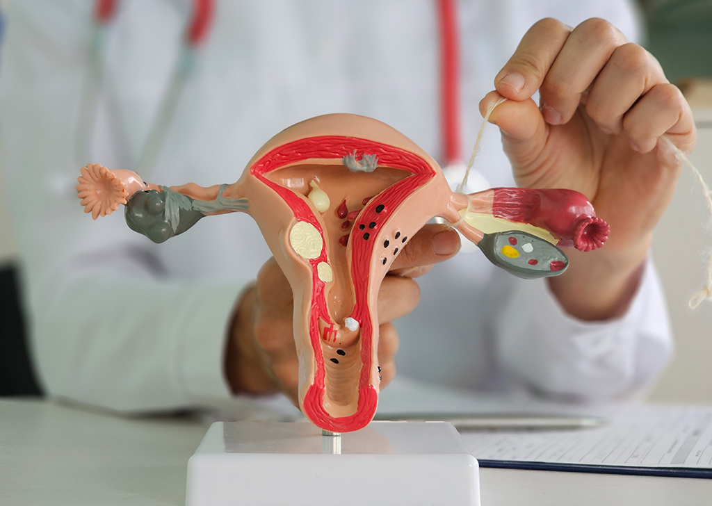 Gravidez após laqueadura é mais comum do que se imagina, diz estudo