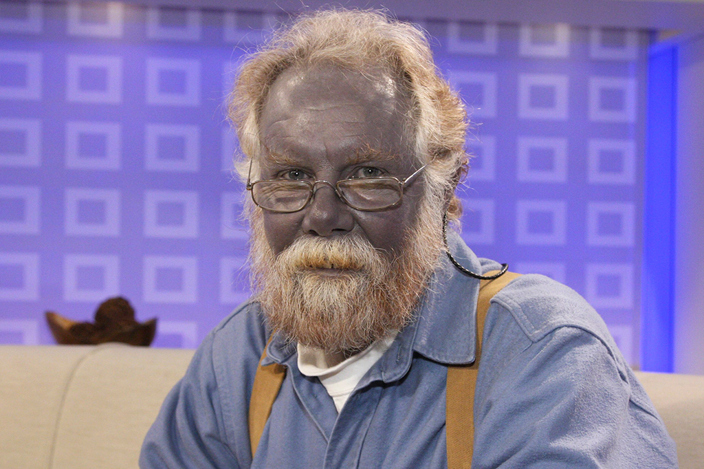 Argiria: a rara doença que deixa a pele azul – para sempre