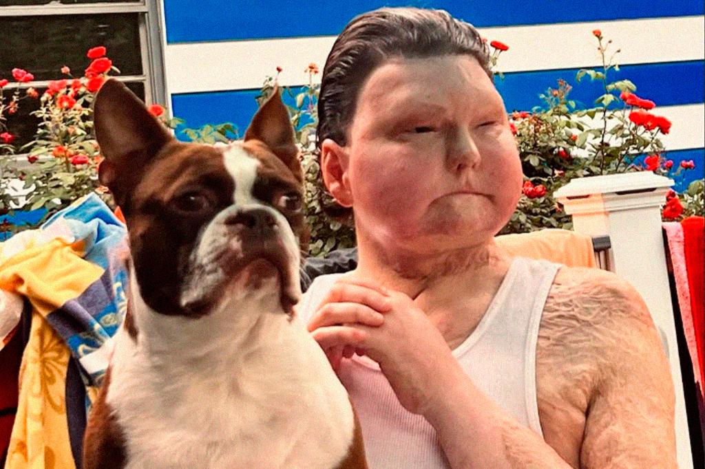 “Eu só queria minha independência de volta”, diz primeiro homem a receber um novo rosto e duas mãos