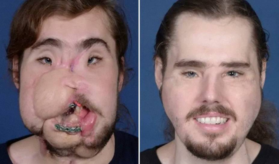 Antes e depois do paciente Cameron Underwood, que fez o transplante em 2017