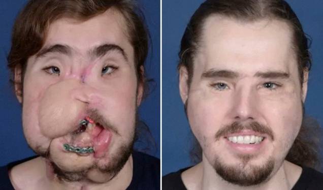 Antes e depois do paciente Cameron Underwood, que fez o transplante em 2017 Antes e depois do paciente Cameron Underwood, que fez o transplante em 2017