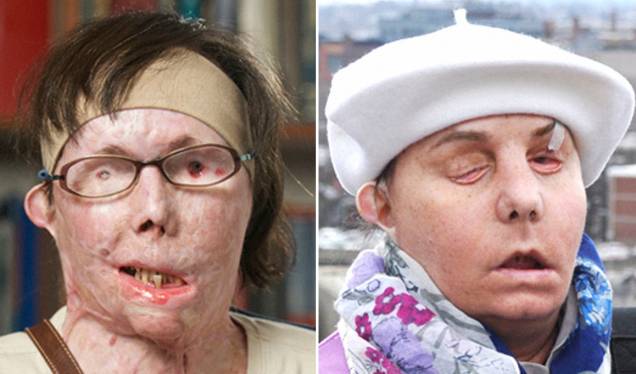 Antes e depois da paciente Carmen Blandin, que fez o transplante em 2013 Antes e depois da paciente Carmen Blandin, que fez o transplante em 2013
